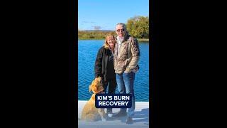 Kim's Story | Burn Victim