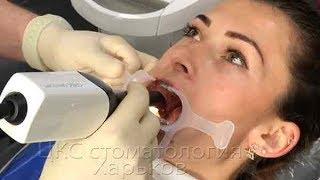 CEREC цифровые слепки зубов с брекетами