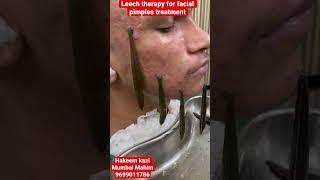 Leech therapy for face benefits? 8 sepA12 #leechtherapy#leech#kzhijama#pimples#acne#scar#skin#shorts