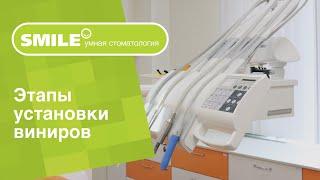  Из каких этапов состоит установка виниров