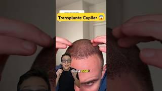 Transplante Capilar #medicina #medico #enfermagem #enfermeiro #enfermeira Antes e Depois Implante