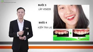 Dán sứ Veneer CHUẨN và những điều cần biết