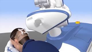 ARTAS Hair Transplant Procedure