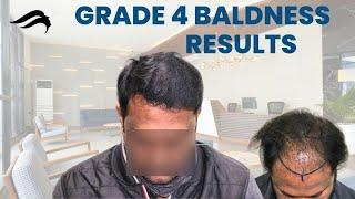 Hair Transplant In Salem | Best  Results Cost  & Surgeon Of Hair Transplant In Salem