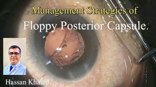 Management Strategies of  Floppy Posterior Capsule