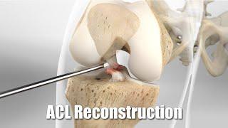 Repairing an ACL injury using a tendon from your own hamstring.