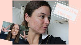 THIS ACNE TREATMENT SAVED MY SKIN!!