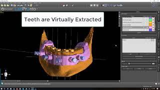 Using Blue Sky Plan for Bone Reduction Guide, Drilling Guide, and Immediate Prosthesis