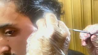 Young Man’s Hearing Restored After Removal of Deep Impacted Wax