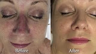 Microdermabrasion: Regenerate Healthy Smooth Skin, Remove Age Spots Call (604) 696-5506  - Vancouver