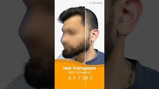 ⭐Hair Transplant Results Before & After | Hair Transformation #shorts #shortsfeed