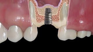 Sinus Lift Kit being used non guided