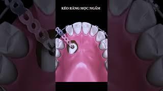 Kỹ thuật kéo răng mọc ngầm khi niềng răng #shorts #braces #orthodontist