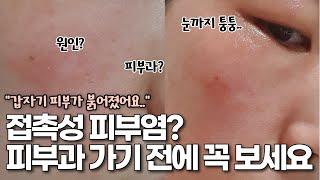 (ENG)화장품 바꾸고 가려움, 붉어짐, 화끈거림이 생겼다면? 나이아신아마이드 접촉성피부염 원인 증상 치료 연고 스킨케어 피부과 비용까지 총정리!