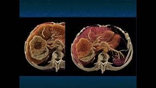 Renal Tumors Beyond Renal Cell Carcinoma: Pearls, Pitfalls and Key Diagnostic Findings - Part 2