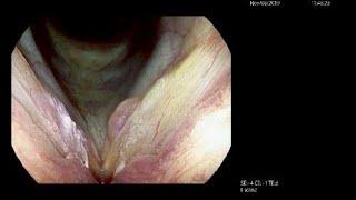 Vocal Cord Polyp with Opposite Cord Thickened Irregular Surface