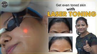 Get even toned skin with Laser Toning