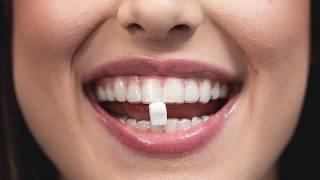 Movemints are the Fresh Mints for Your Invisalign!
