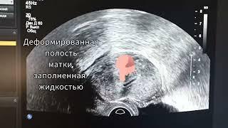 рубец с деформацией полости матки. deformity of the uterine cavity