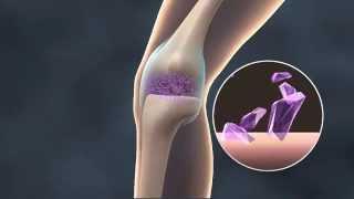 Steroid Therapy for Knee Joint Arthritis - Medical Animation by Watermark