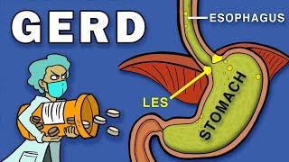 Gastroesophageal Reflux Disease (GERD)