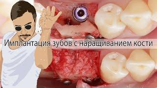 Разбор операции: имплантация с наращиванием костной ткани (B2S / Кури) // implant placement with GBR