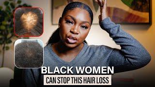 What's the REAL Reason Behind Hair Loss in Black Women?