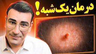 از بین بردن یک شبه زگیل ها و منگوله های پوستی در خانه! | How To Remove Warts At Home Naturally