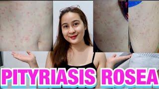 PITYRIASIS ROSEA  (DAPAT at HINDI DAPAT GAWIN) MY SKIN STORYPHILIPPINES