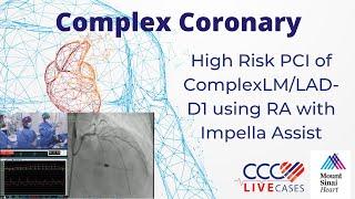 High Risk PCI of Complex﻿LM/LAD-D1 using RA with Impella Assist