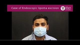 Case Endoscopic Lipoma Excision Surgery: Forehead Lipoma Removal Surgery by Dr. Milan Doshi