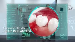 ¿Cómo se colocan los implantes dentales? | VITALDENT