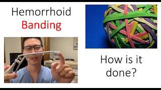 What is a hemorrhoid banding? I show you how it's done!