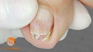 Toenail relief now! I completely release the pressure of the groove | Nail care [Podología Integral]