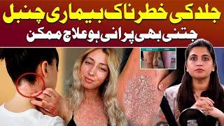 What is Psoriasis? - Psoriasis Causes & Treatment | Chambal Ka Ilaj | Dr Salma Naeem