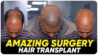 Hair Transplant in Surat | Best Results & Cost of Hair Transplant in Surat