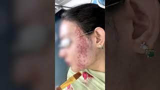 chemical peel treatment for acne | Pimples Treatment | Skinaa Clinic #viral #skinaa_clinic #shorts