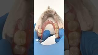 Most affordable option to replace missing teeth #shorts #viralvideo #trending #denture #implants