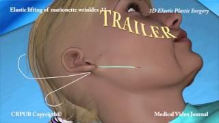 3D Elastic lifting of marionette wrinkles  11