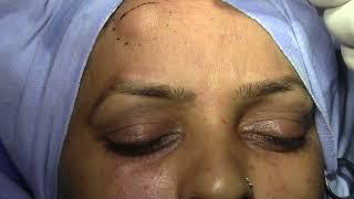 Lipoma Forehead:Excision under Supra orbital nerve Block-Non edited Video