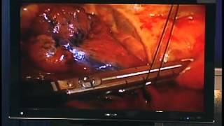 VATS Lobectomy for the Treatment of Non-Small Cell Lung Cancer