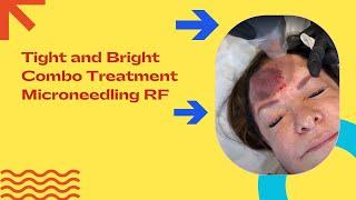 Tight and Bright Combo Treatment | Microneedling RF | Dr. Jason Emer