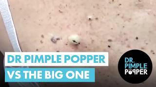 Dr Pimple Popper vs THE BIG ONE