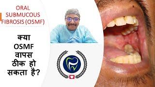 Dr Rudra Mohan | is OSMF reversible ? क्या OSMF वापस ठीक हो सकता है? Oral Submucous Fibrosis