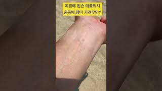 여름에 왼손 Apple Watch 손목 땀띠 나서 가려울때 ?