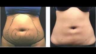 SmartLipo Educational Video