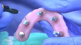 Fully Guided Full Arch - Digitally Guided Full Arch All on 4 Surgery