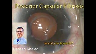 Black Cataract & Posterior Capsular Fibrosis ,Challenging Task