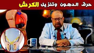 مشروب يساعد فى حرق الدهون وتنزيل الكرش  | دكتور جودة محمد عواد | دكتور جودة محمد عواد