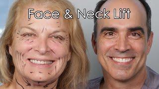 Facelift Los Angeles: Top Plastic Surgeon Dr. David Stoker on Facelift, Eyelid, & Laser Surgery